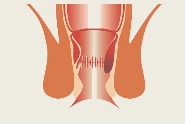 stage1_lahemorrhoid