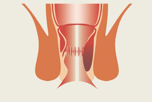 stage2_lahemorrhoid