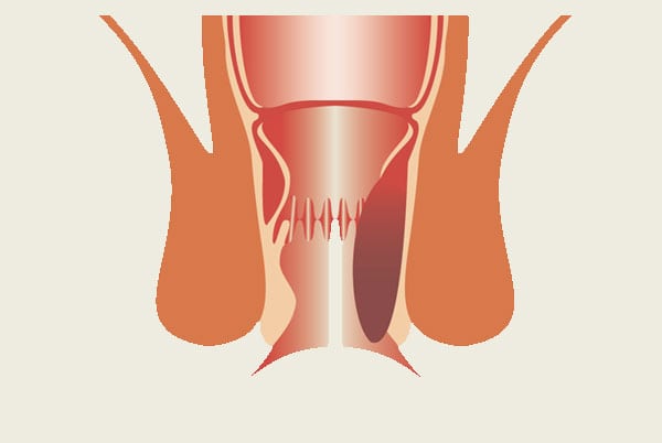 stage3_lahemorrhoid