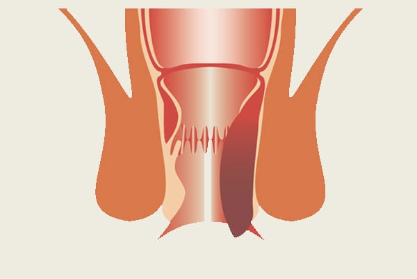 stage4_lahemorrhoid