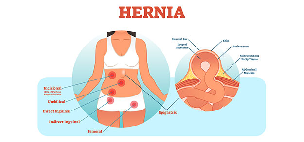 Epigastric-Hernia-Los-Angeles-Hemorrhoid-Clinic