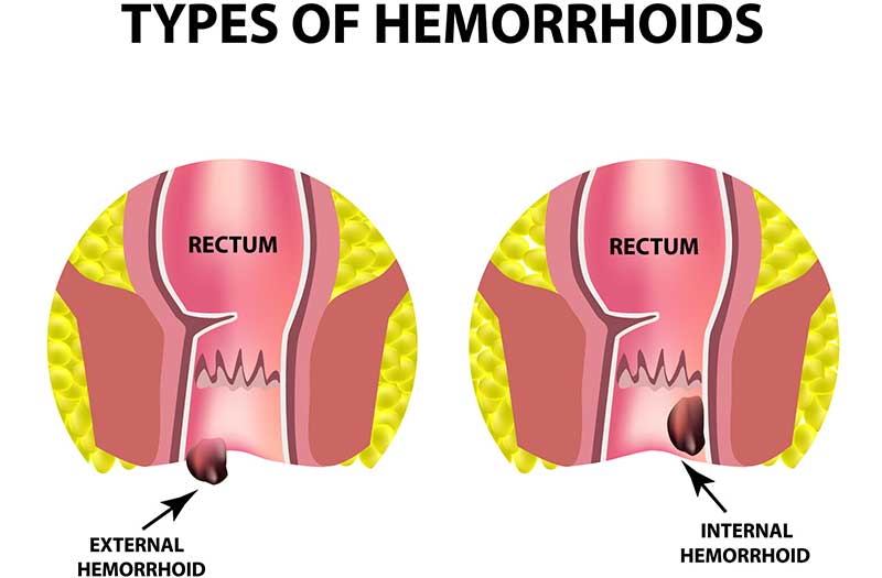 Hemorrhoid-Treatment-Center-in-Los-Angeles-LA-Hemorrhoid-Clinic